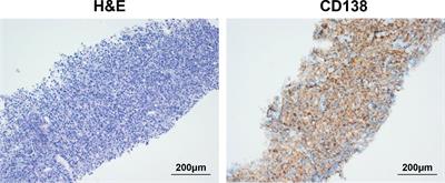 Case report: Cryoablation as a novel bridging strategy prior to CAR-T cell therapy for B cell malignancies with bulky disease